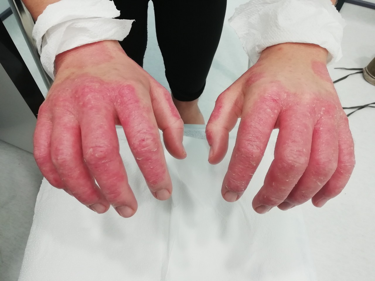 Clinical Case with Persistent Psoriasis
