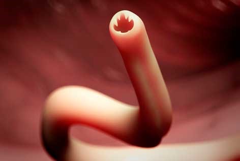 Ancylostoma duodenale